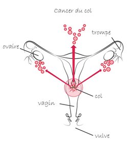 Cervix cancer